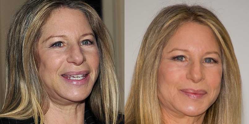 The Miraculous Face of Barbra Streisand – Did She Had Plastic Surgery?